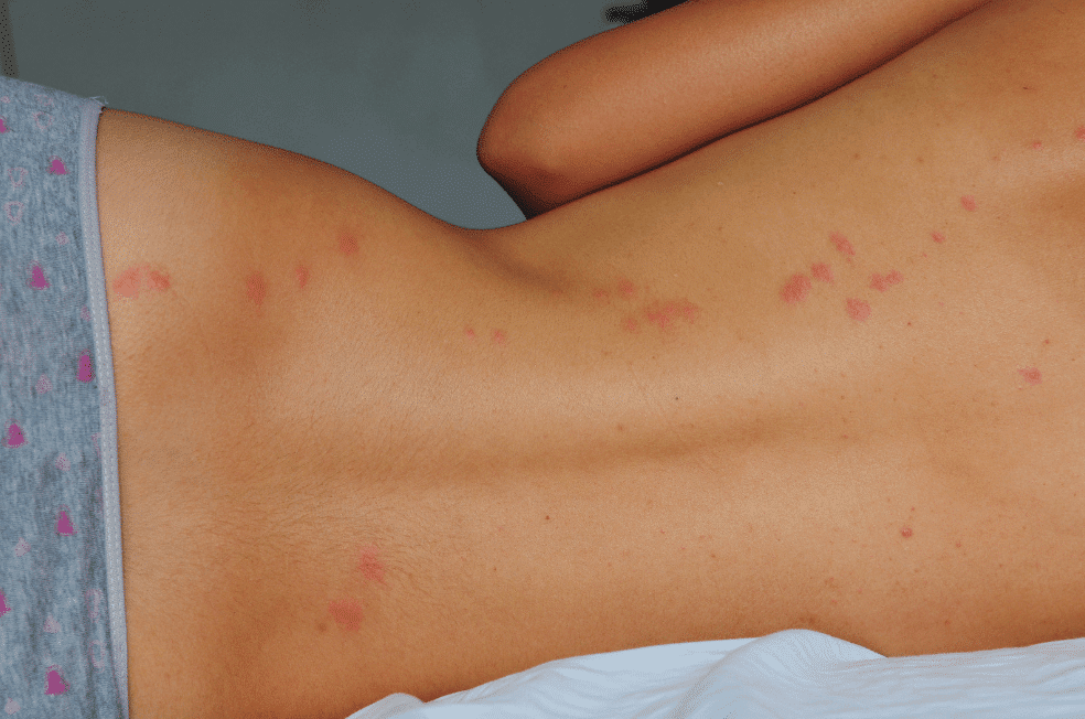 piqure punaise de lit 94 sur le dos d'une personne